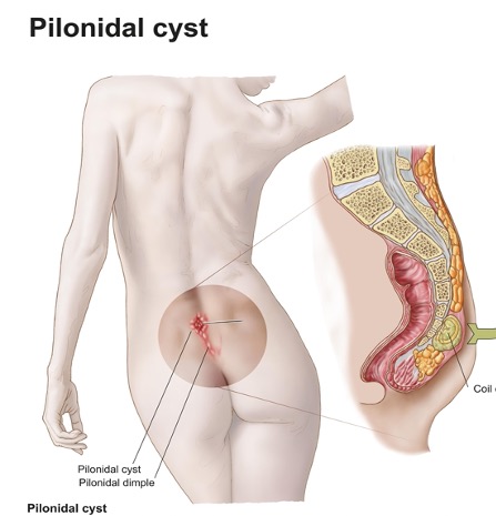 pilonidal sinus patient